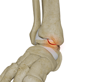 https://drpiyushkanani.com/wp-content/uploads/2025/05/osteochondral-lesions.png